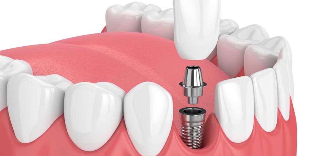 dental implants banner 2